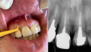 Случай трещины в зубе 12